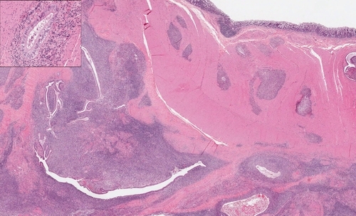 Endometriose - Doença benigna de origem multifatorial