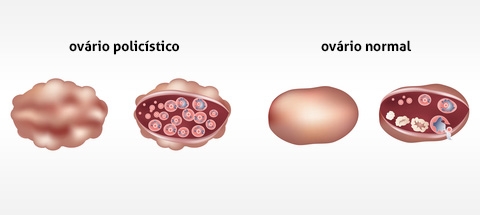 Ovários Policísticos - O Que é, Causas e Sintomas, Prevenção e Tratamentos