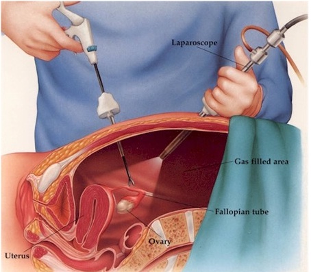 O uso da laparoscopia para a realização das cirurgias de retirada dos focos  visíveis da endometriose tem se mostrado superior à técnica abdominal, By Dr. Yulo Césare