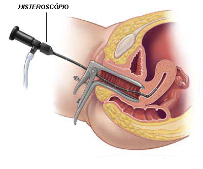 Vídeo Histeroscopia Diagnsotica